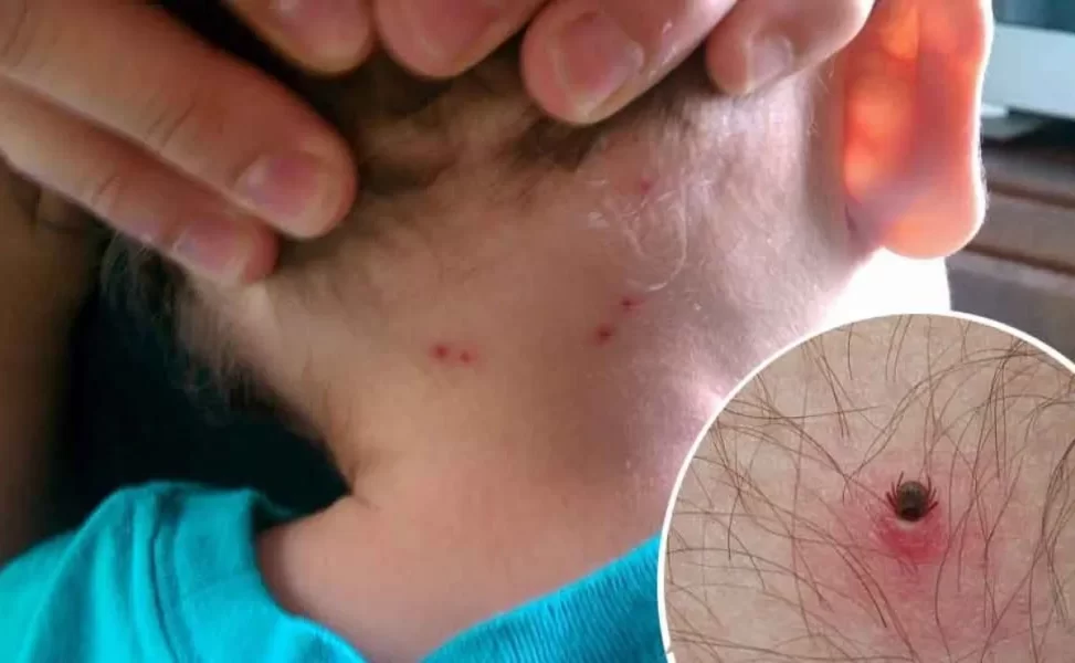 41% DE LOS PACIENTES POR RICKETTSIA MURIERON EN B.C